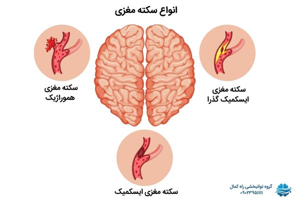 انواع سکته مغزی
