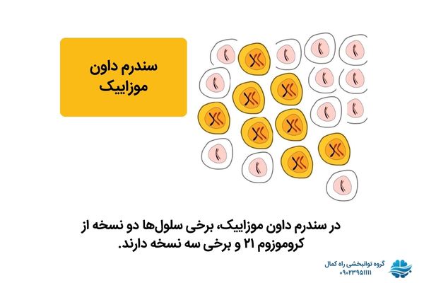 اختلاف کروموزومی در تریزومی 21