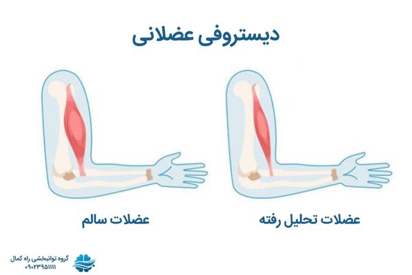 دیستروفی عضلانی