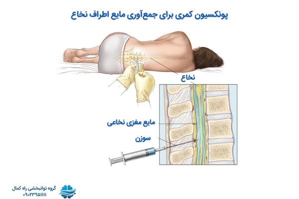 پونکسیون کمری