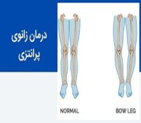 درمان پای پرانتزی - درمان با حرکات اصلاحی  و استفاده از بریس