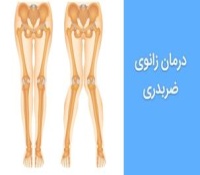 درمان زانوی ضربدری - درمان با حرکات اصلاحی  و استفاده از بریس