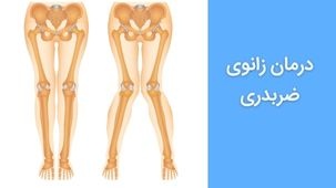 درمان زانوی ضربدری - درمان با حرکات اصلاحی  و استفاده از بریس